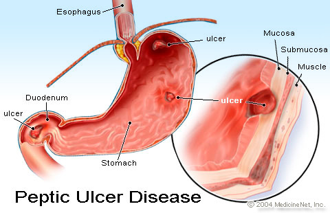 ulcer stomacal din punct de vedere genetic